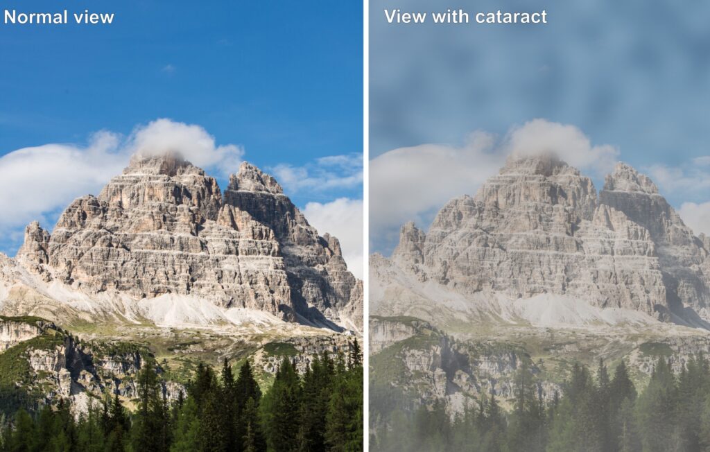view of a mountain, comparing between what normal vision and the vision of patient suffering from cataract looks like