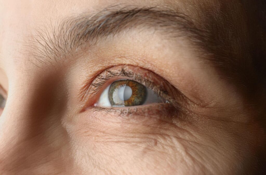 A close up of an eye with a cataract.